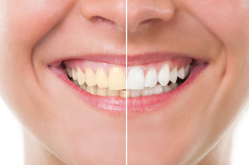 Teeth Whitening - Roxana R. Sayah, DDS, Los Angeles Dentist